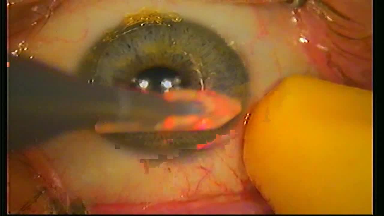 Epi-Bowman Keratectomy (EBK)