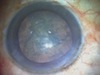 Glued Endocapsular Hemi-Ring Segments for Suturele