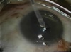 Intraocular Parasites - Part 2