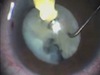 Manual Torsional Phacoemulsification - A Simple Approach