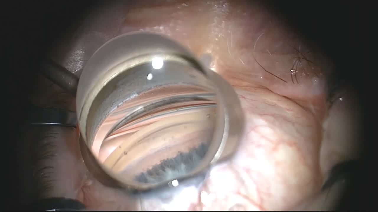 Excisional Goniotomy With the Kahook Dual Blade, Using Trypan Blue