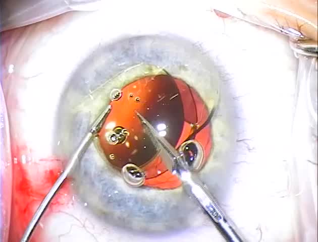 IOL Exchange In-the-bag Scaffold Technique