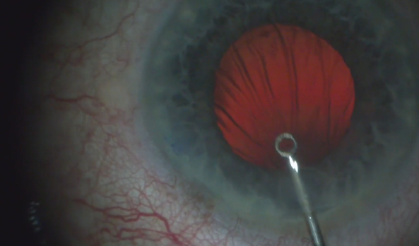 Aspheric Toric IOL in an Eye With a Torn Posterior Capsule and Stable Bag
