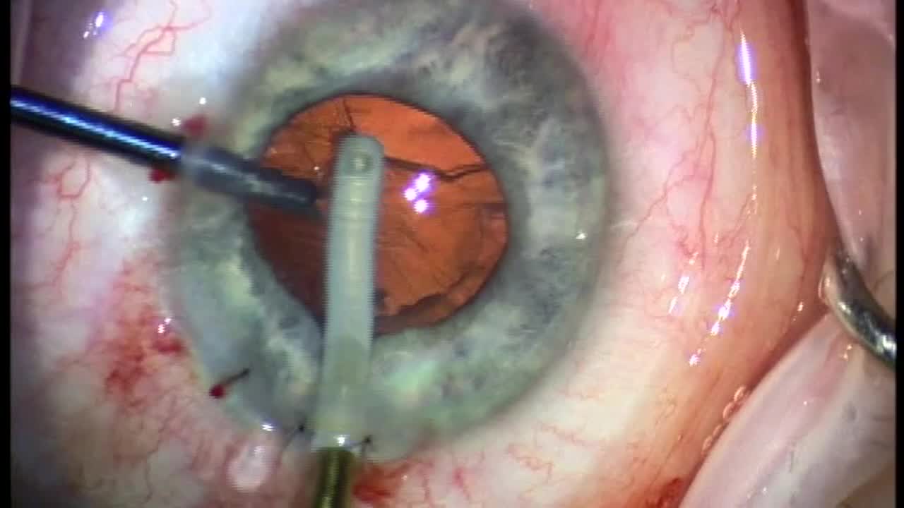 FLACS With SICS and Verisyse Removal