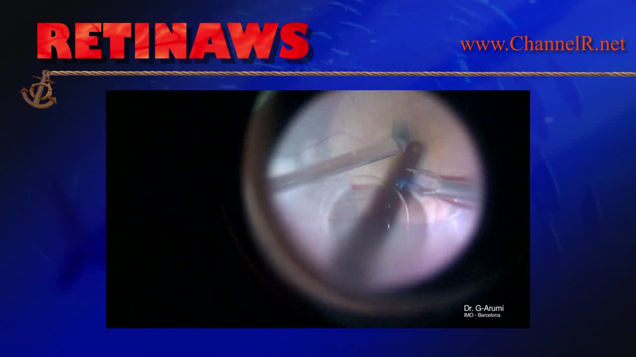 Recurrent Macular Hole