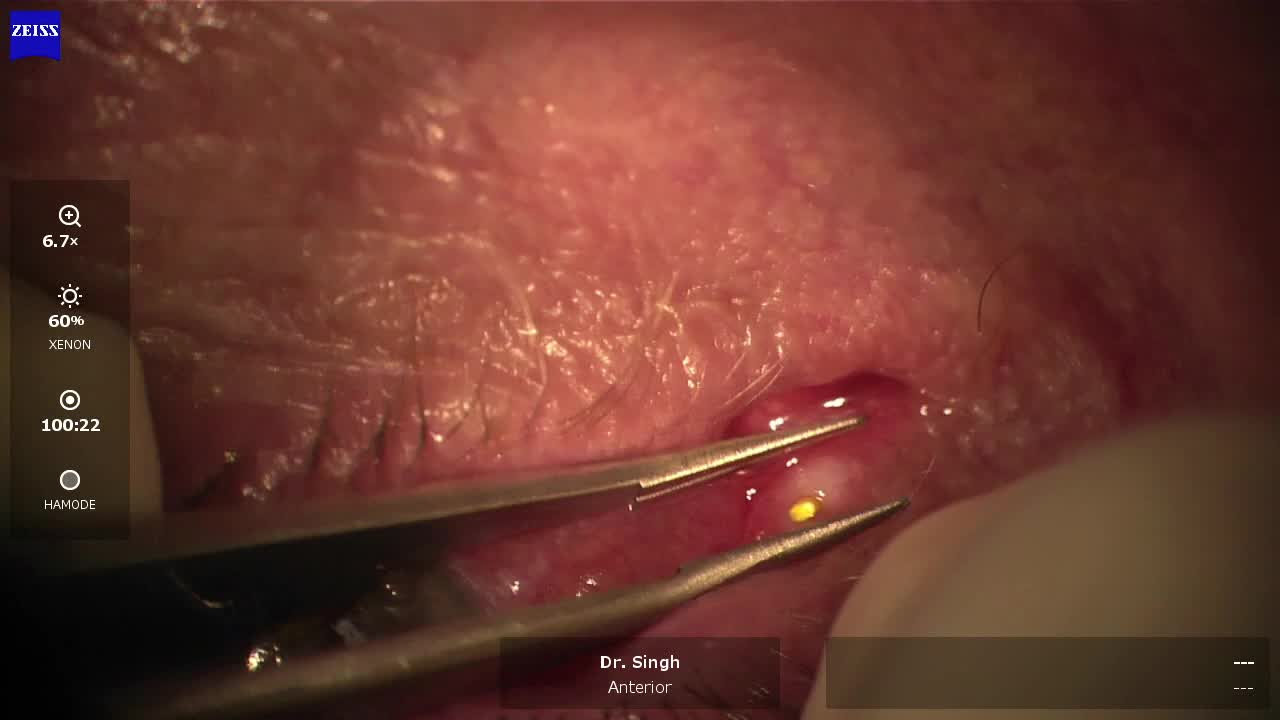 Upper and Lower Canalicular Dextenza Insertion After Glaucoma Surgery