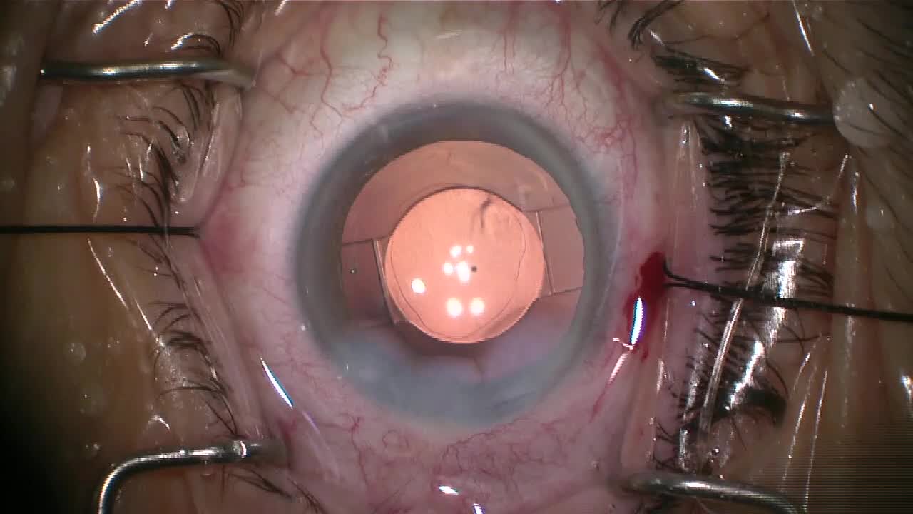  iStent Using the iPrism with a Premium IOL