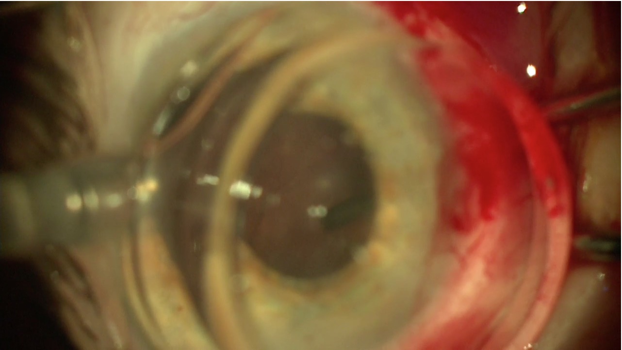 Cataract Following PPV
