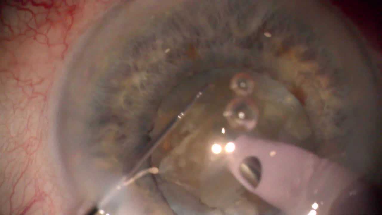 Microchop in Brunescent Cataract