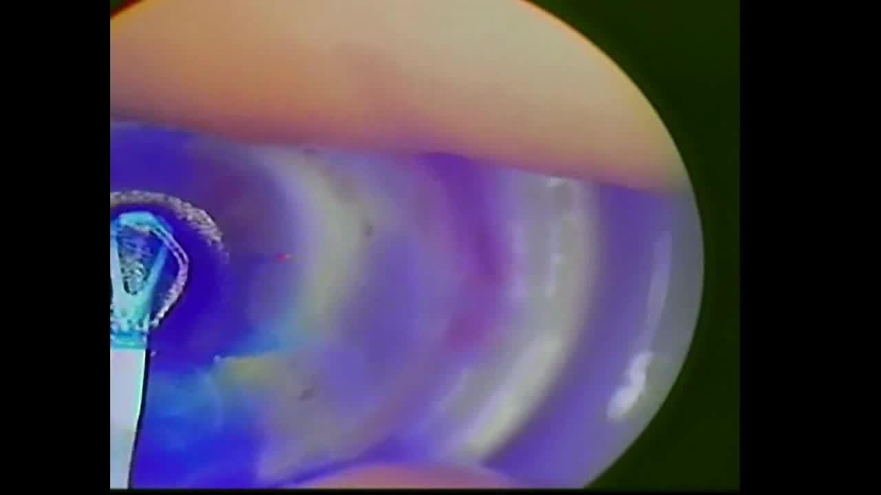 Small-Incision Lenticule Keratoplasty (sLIKE): A Modification of the Lenticule Intrastromal Keratoplasty (LIKE) Procedure for the Correction of High Hyperopia