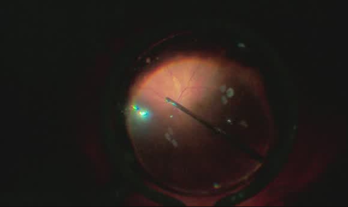 Retinal Detachment: Remove the Subretinal Fluid? [FLOREtina Live Surgery]