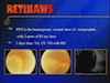 Retinal Capillary Hemangioma