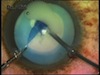 White Cataract