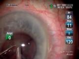 Torsional Phaco Procedure