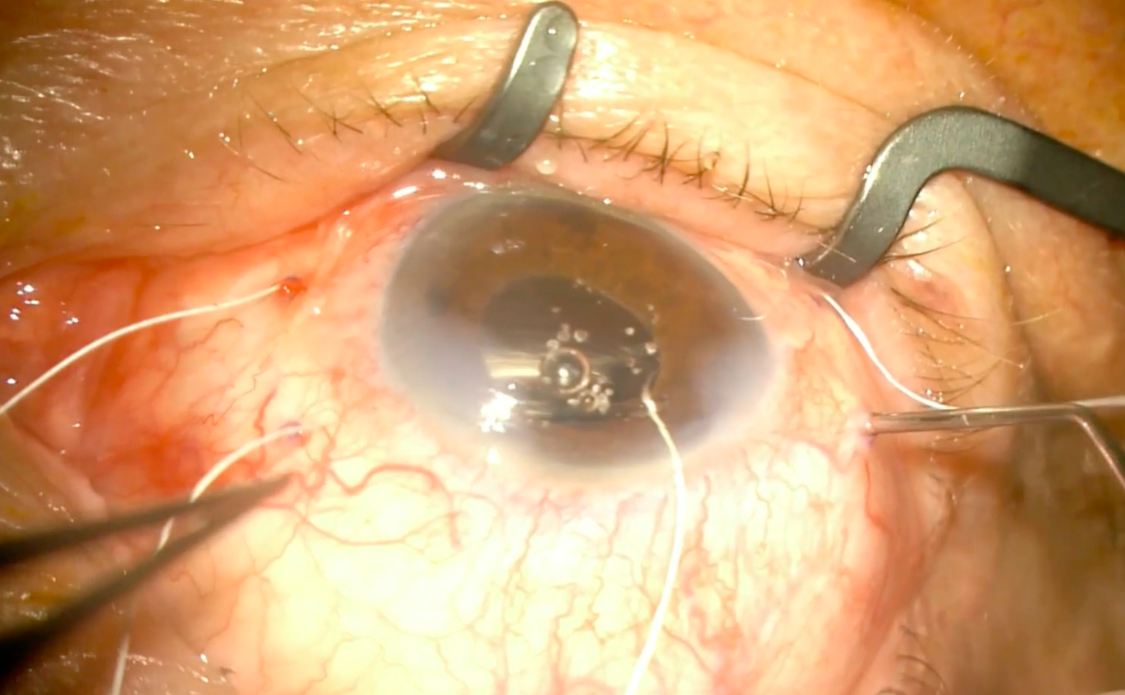 Scleral IOL Suspension