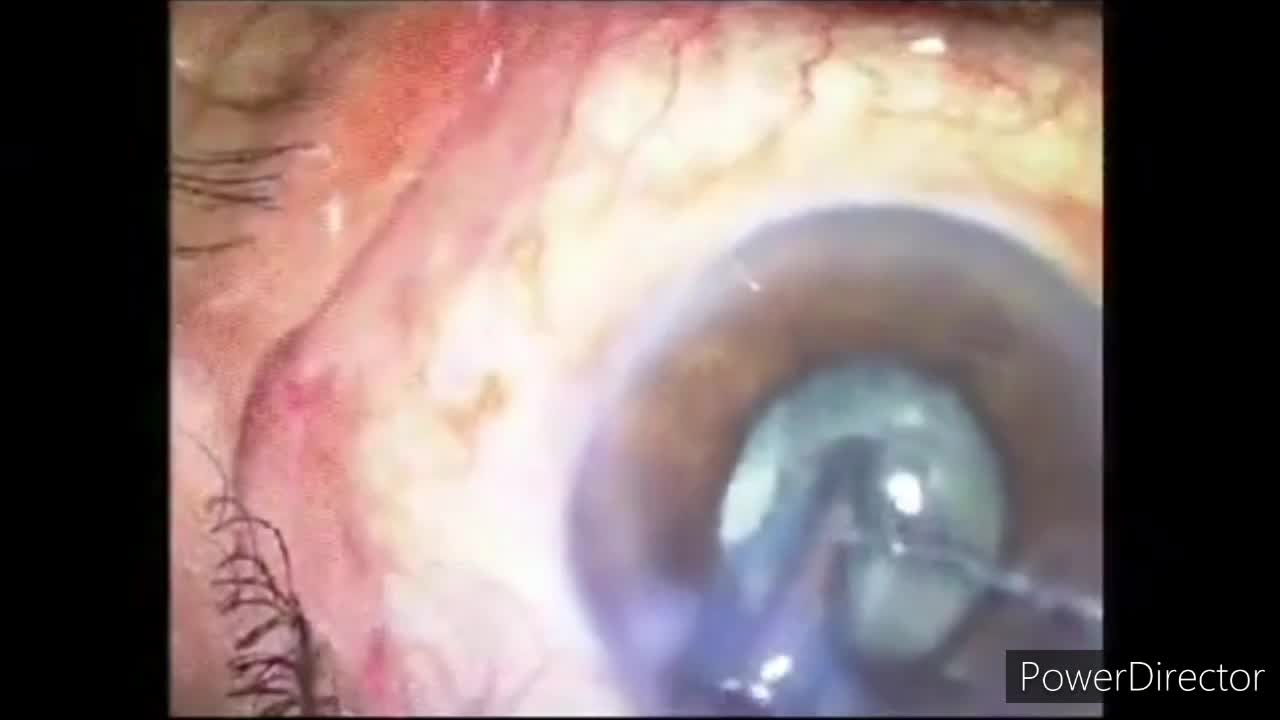 Small Pupil