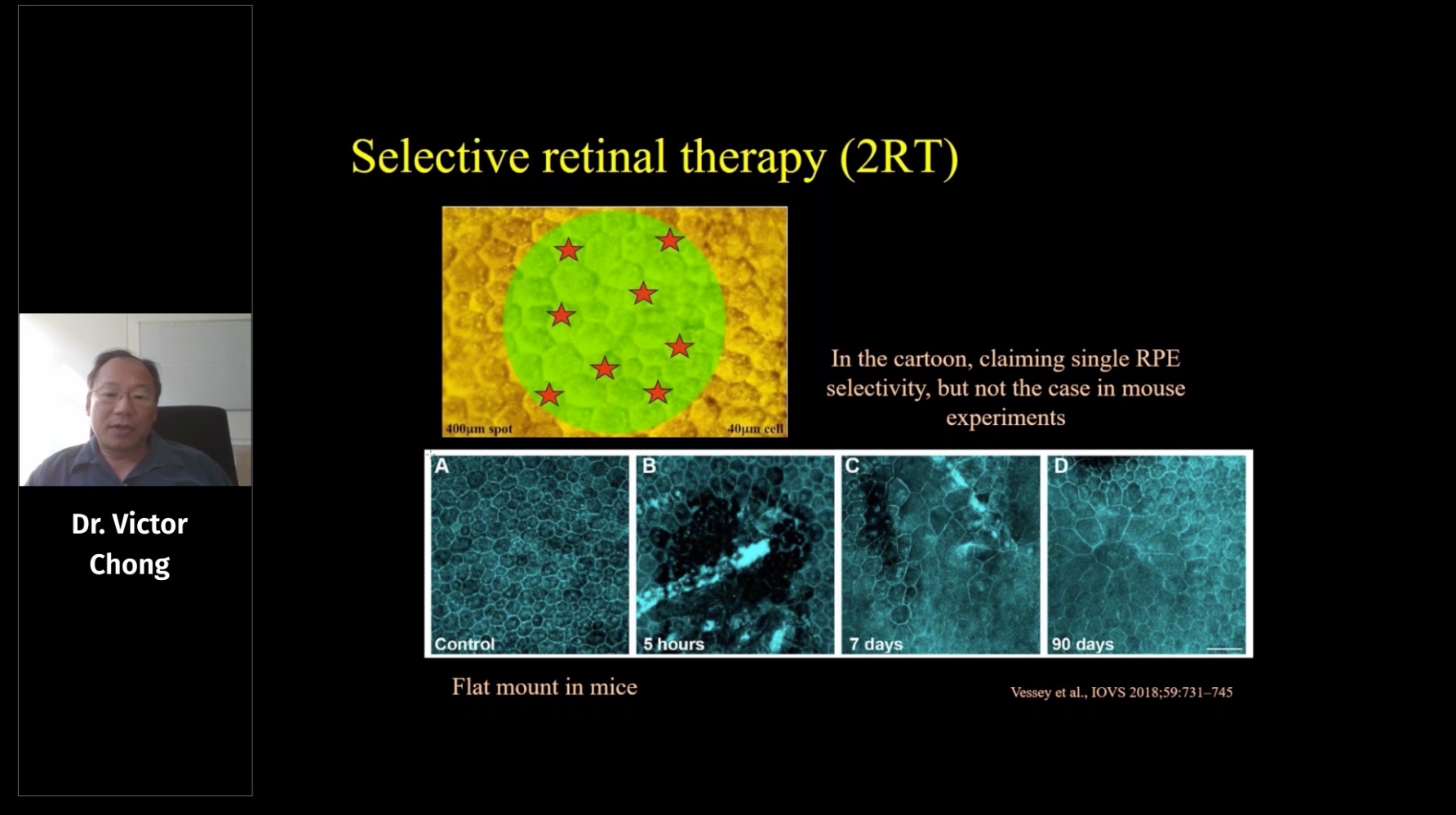 SubLiminal Laser for AMD