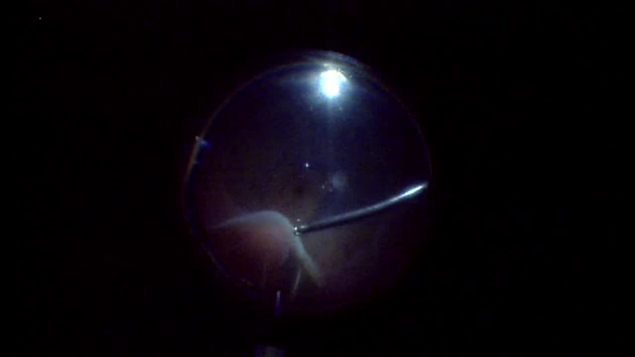 Triple Procedure With Chronic Macular Hole, Subluxated IOL, and Retinal Detachment