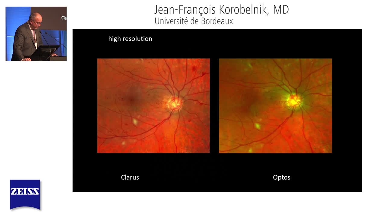 A Comparative Look: ZEISS CLARUS 500 Versus Legacy Ultra-Widefield Systems