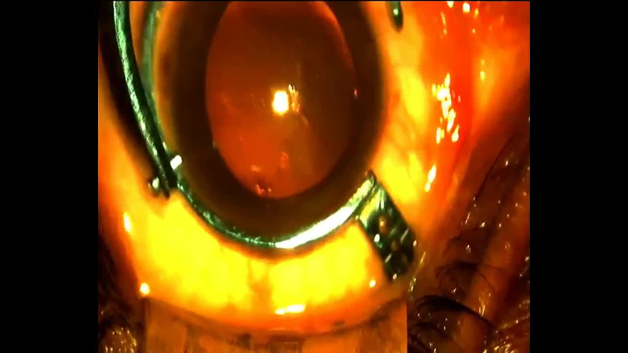 Hans Multipurpose Intravitreal Guide