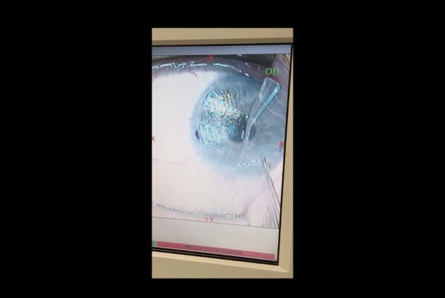 Flap Removal for Recurrent Epithelial Ingrowth