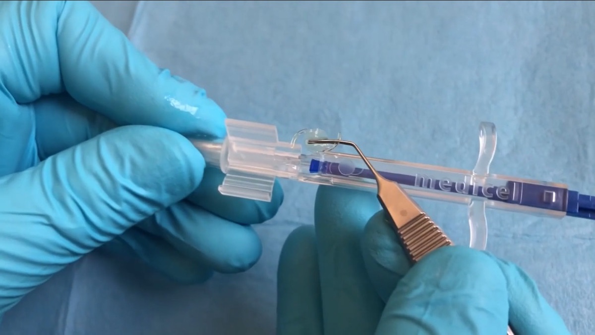 Implantation Behavior of the Acunex Vario IOL