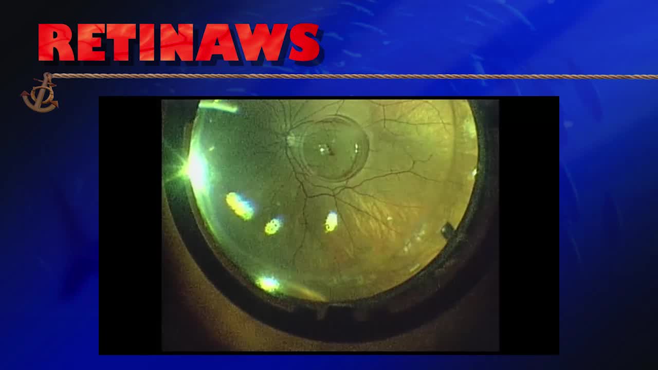 Macular Hole Surgery