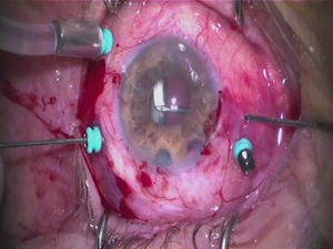 Pocket IOL Rescue