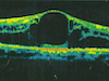 Vitrectomy Combined With Suprachoroidal Steroid Delivery - Part 1