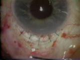 A microscopic look at the biocompatibility of IOLs