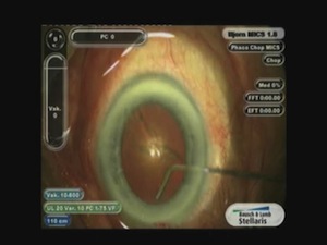 Precise and Effective Technique for Hydrodissection