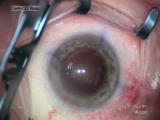 Micro-coaxial phaco