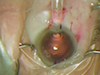 Implantation of the Lentis Mplus Toric 