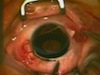 The Sundmacher-Morcher Aniridia IOL