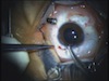 Marfan Syndrome