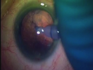 Transpupillary, Trans Posterior Capsulotomy Vitrectomy 