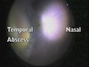 Chandelier Abscess