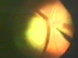 Internal Resection of Choroidal Melanoma