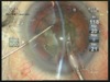 Posterior Polar Cataract - When it Drops!