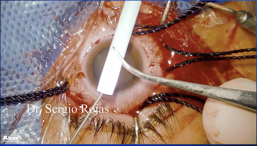Scleral Buckle