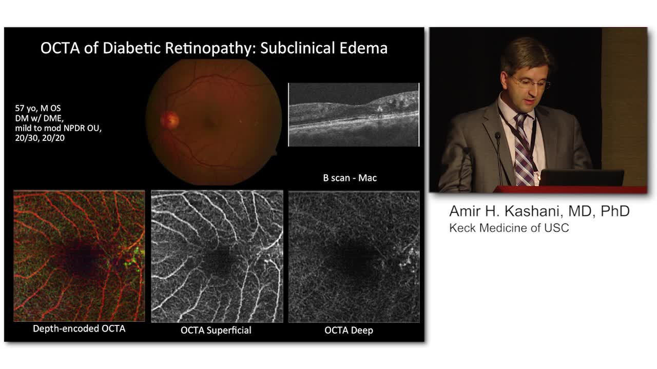OCT-A For Early DR Disease Detection