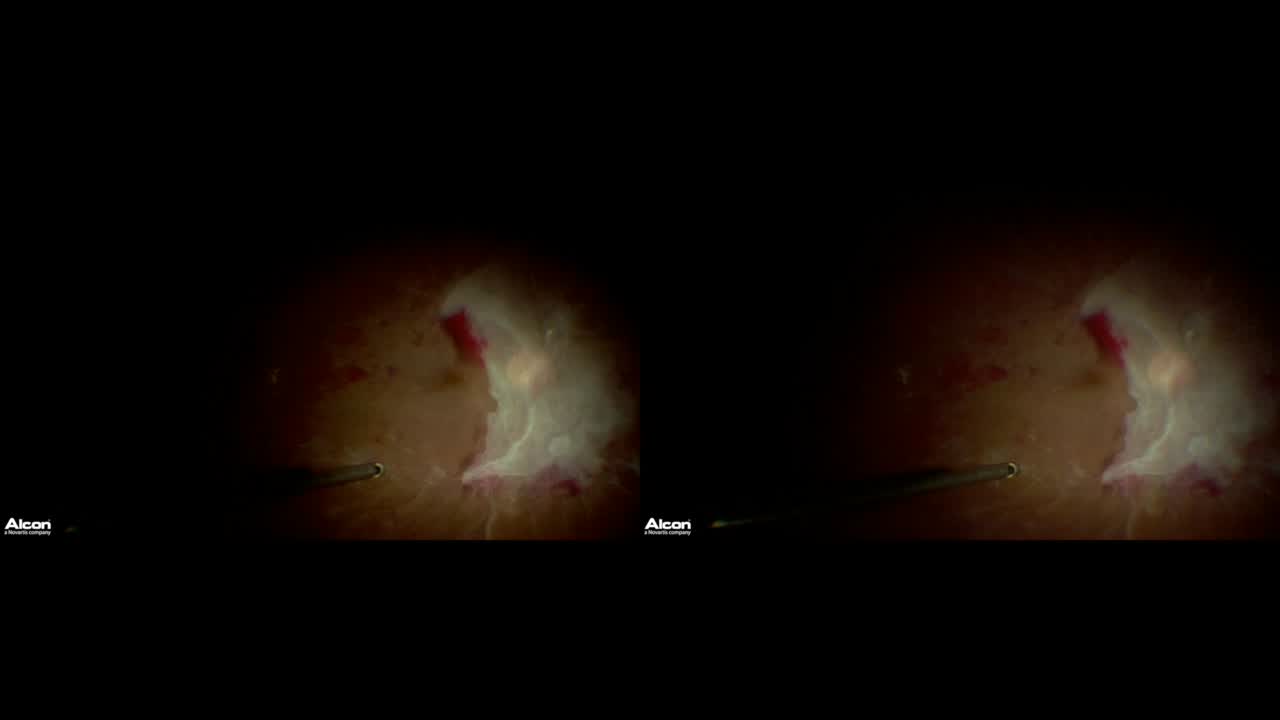 Repair of a Diabetic TRD With a 25-Gauge High-Speed Beveled Cutter