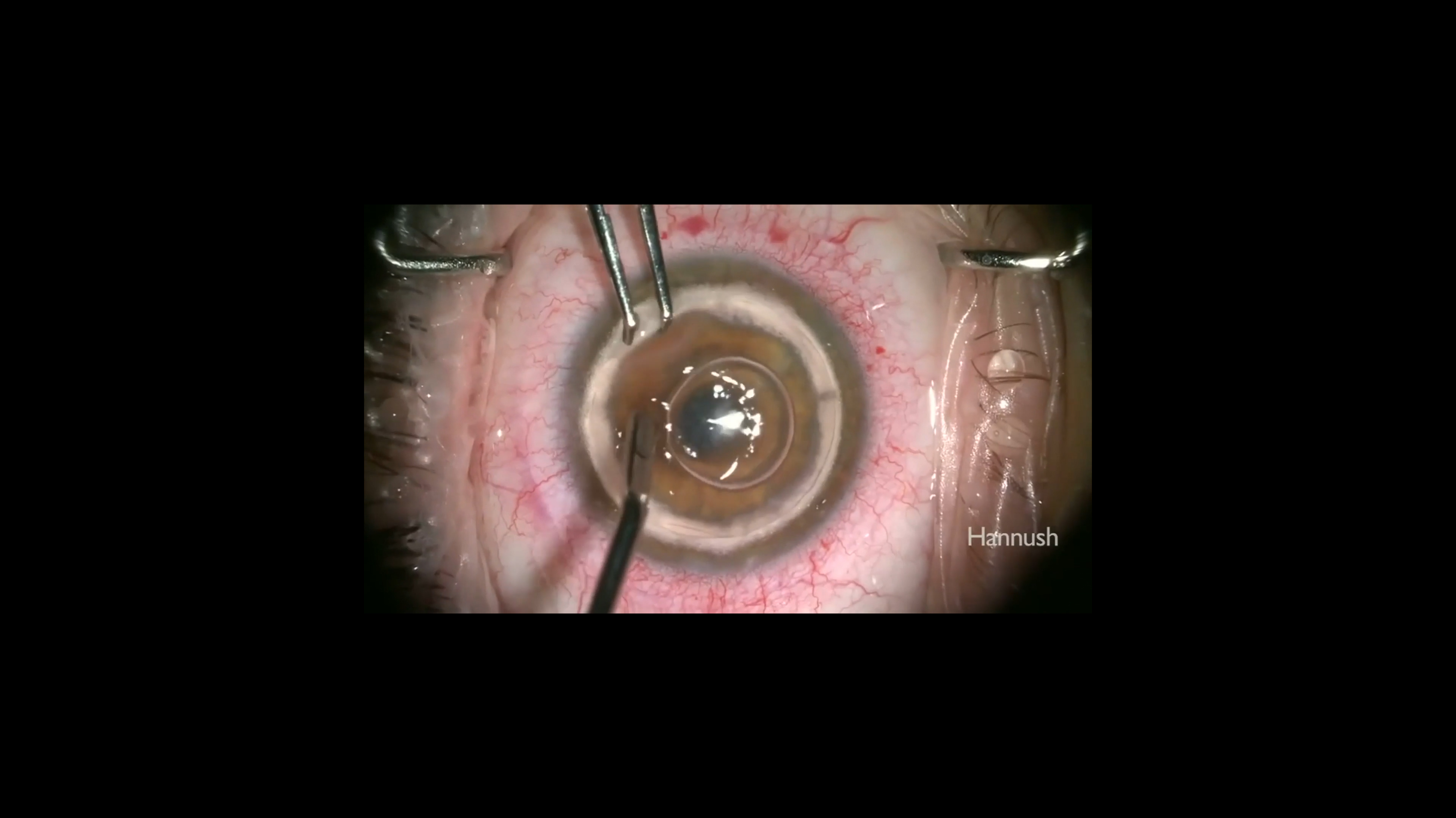 DALK for Progressive Keratoconus