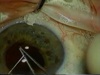 Peripupillary Membranectomy