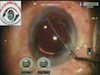 Pearls for Phaco in Small Pupil