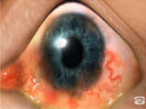 Topical Steroids and Ocular Inflammation