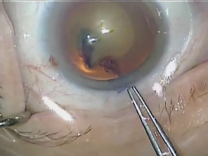 Phacoemulsification in a Patient With True Exfoliation Syndrome