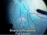 Biopsy of Retinal Lesions with a Novel Sub-Retinal Aspiration Cannula