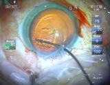 The Key to Successful Hydrodissection