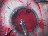 Microspherophakia